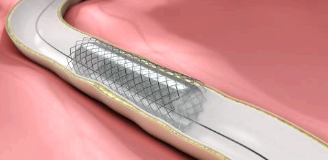 Bei einem Aneurysma wird das Gefäß an den Gefäßinnenwänden mit einem sogenannten Stent verbunden