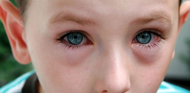 Gerötete Augen beim Kind: Allergien, Bindehautentzündung, Fremdkörper, Augenherpes kommen als Ursachen in Frage