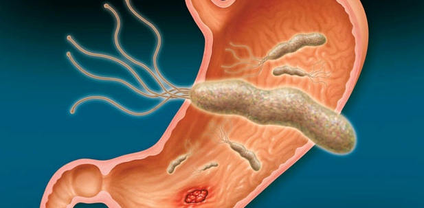 Helicobacter pylori Hauptverursacher von Magengeschwüren