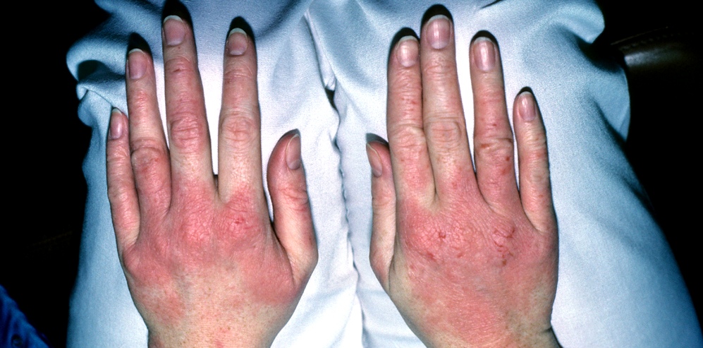 Ekzeme: Eine Kontaktdermatitis auf Händen