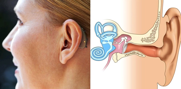 Cochlea-Implantat wie ein normales Hörgerät