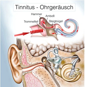 Tinnitus Ohrgeräusch Illustration Innenohr